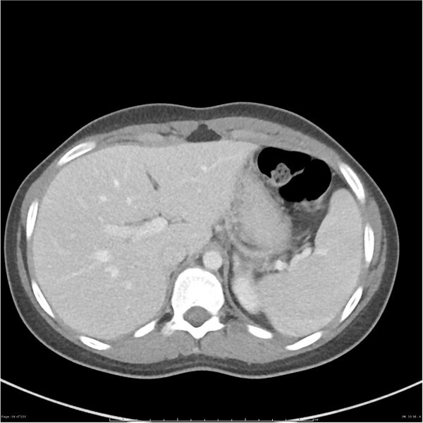 File:Bilateral ureteritis and cystitis (Radiopaedia 25340-25594 A 13).jpg
