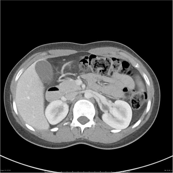 File:Bilateral ureteritis and cystitis (Radiopaedia 25340-25594 A 24).jpg