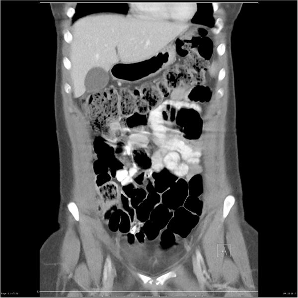 File:Bilateral ureteritis and cystitis (Radiopaedia 25340-25594 B 11).jpg