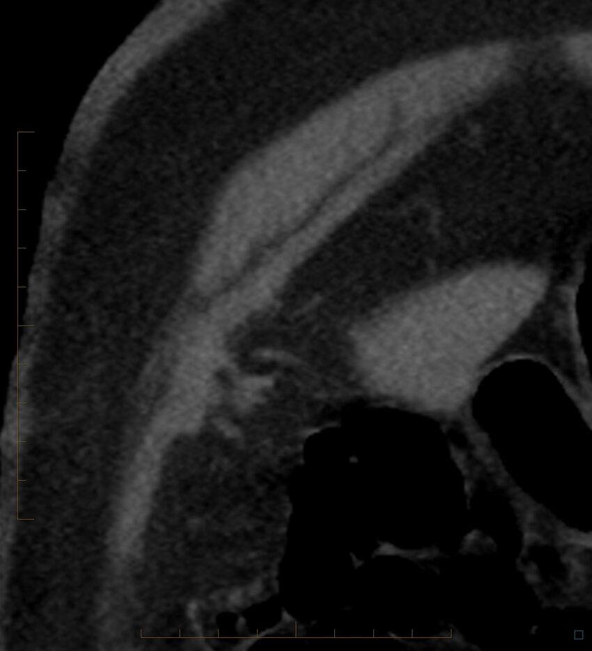 Bile leak from accessory duct(s) of Luschka post cholecystectomy (Radiopaedia 40736-43389 B 2).jpg