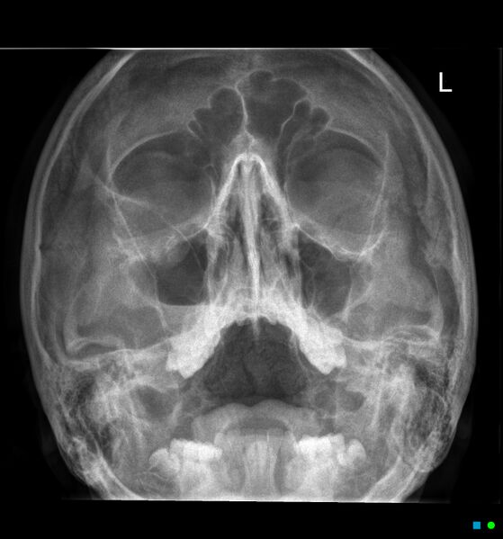 File:Blow-out fracture right orbital floor (Radiopaedia 19329-19346 Frontal 1).jpg