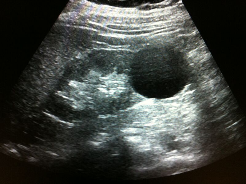 File:Bosniak renal cyst - type I (Radiopaedia 21139).jpg