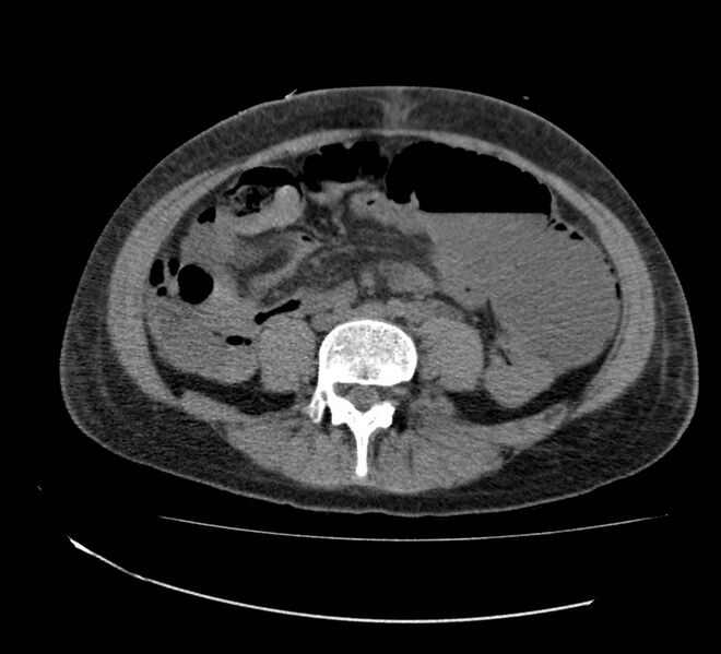File:Bowel lymphoma complicated by bleeding after therapy (Radiopaedia 55601-62110 Axial non-contrast 51).jpg