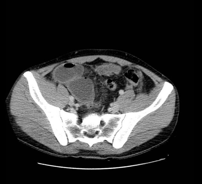 File:Bowel obstruction from colon carcinoma (Radiopaedia 22995-23028 A 67).jpg