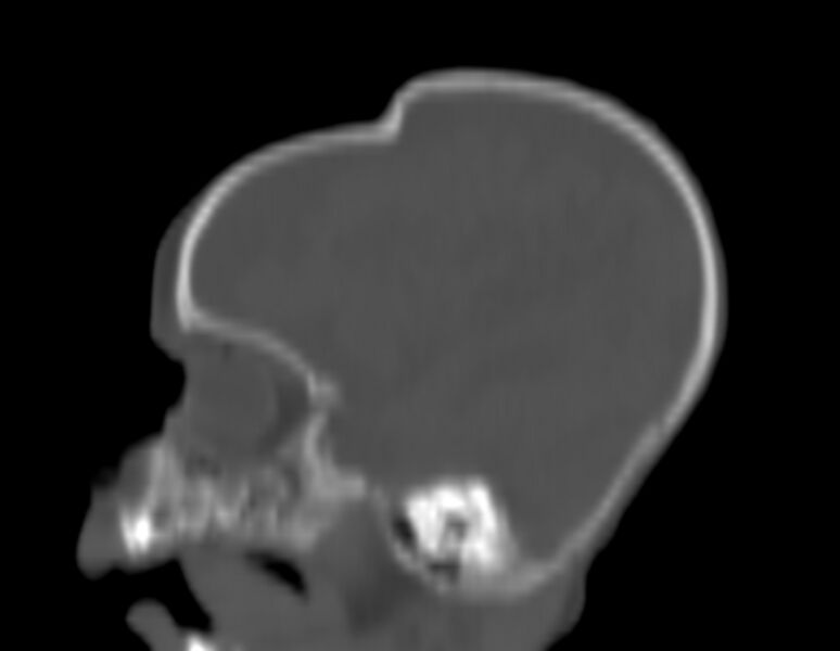 File:Brachycephaly (bi-coronal and bi-lambdoid synostosis) (Radiopaedia 55048-61413 Sagittal bone window 11).jpg