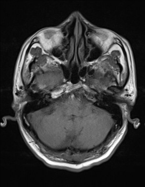 File:Brain abscess with ventriculitis (Radiopaedia 85703-101495 Axial T1 5).jpg