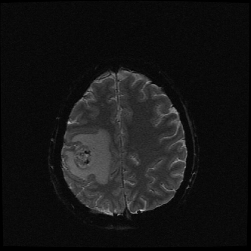 Brain metastases (renal cell carcinoma) (Radiopaedia 42571-45704 Axial SWI 13).jpg