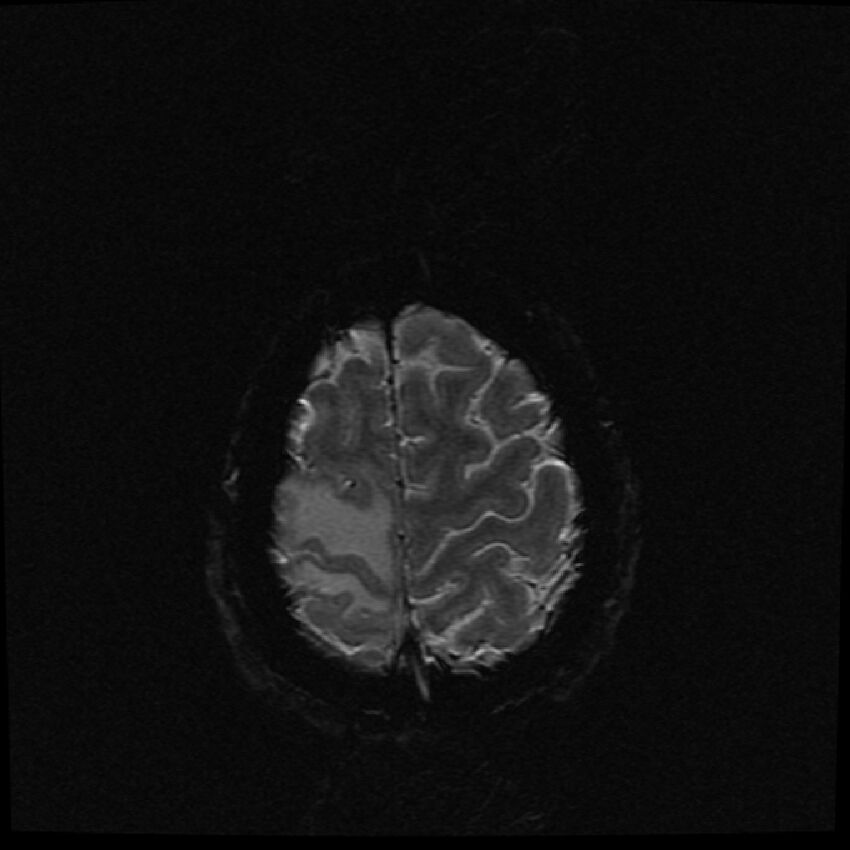 Brain metastases (renal cell carcinoma) (Radiopaedia 42571-45704 Axial SWI 3).jpg
