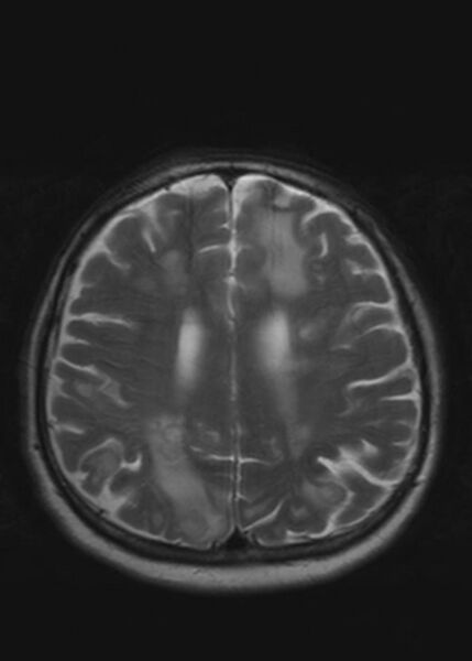 File:Brain metastases from squamocellular lung cancer (Radiopaedia 56515-63222 Axial T2 18).jpg