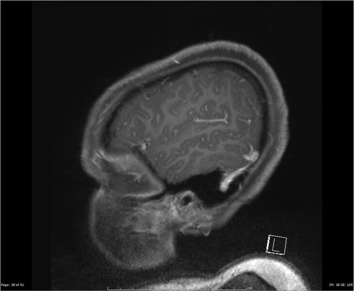 File:Brainstem glioma (Radiopaedia 21819-21775 D 38).jpg