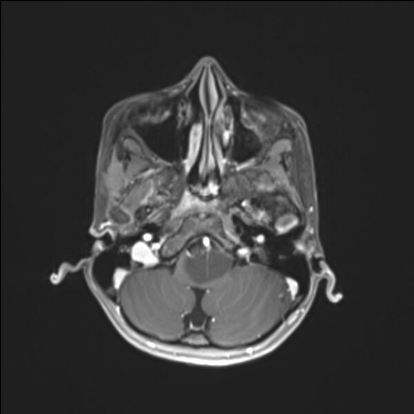 File:Brainstem glioma (Radiopaedia 70548-80674 Axial T1 C+ 33).jpg
