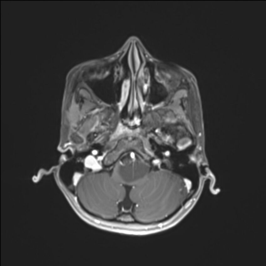Brainstem glioma (Radiopaedia 70548-80674 Axial T1 C+ 33).jpg