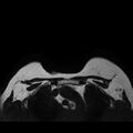 Breast implants - MRI (Radiopaedia 26864-27035 Axial T2 43).jpg