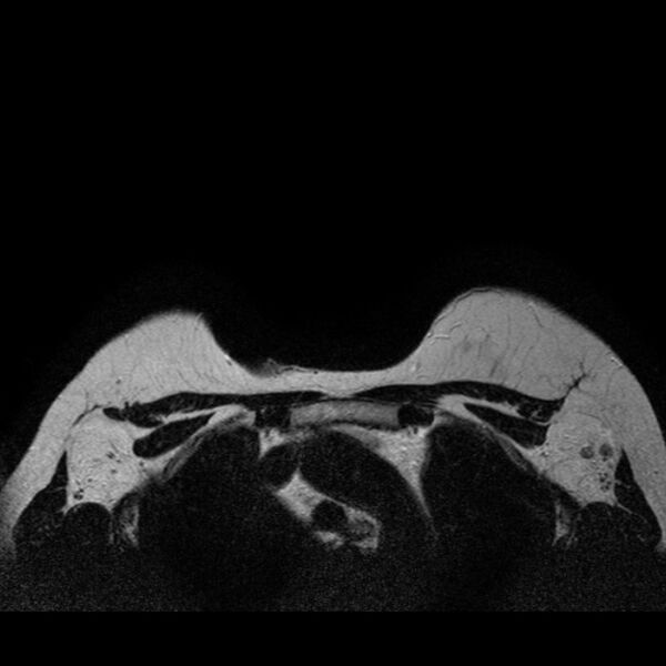 File:Breast implants - MRI (Radiopaedia 26864-27035 Axial T2 43).jpg
