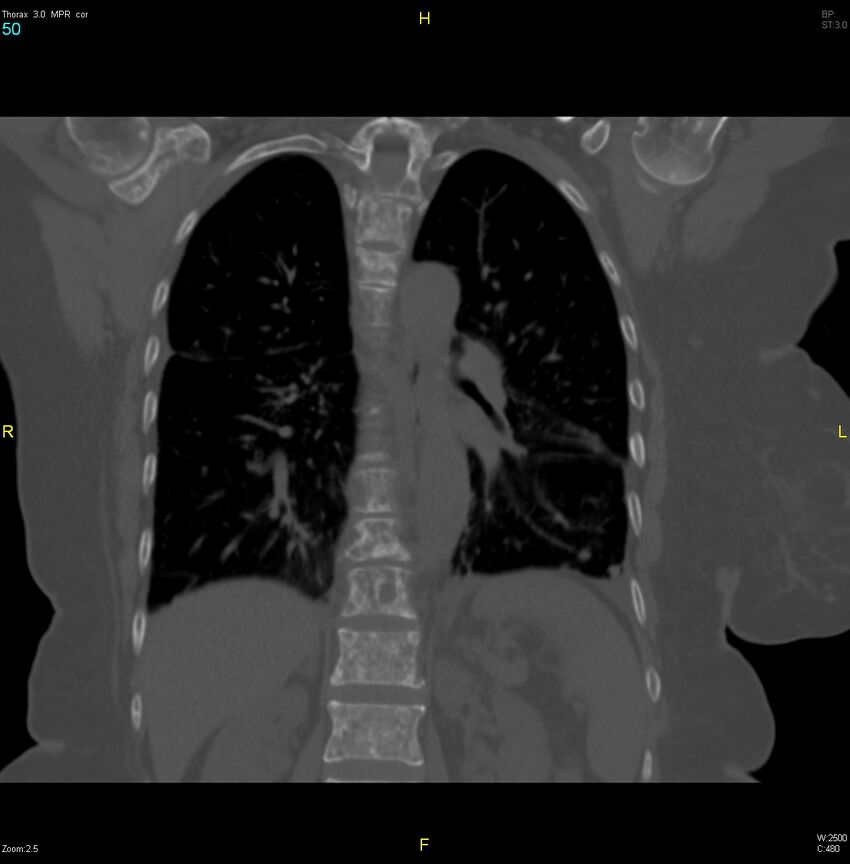 Breast primary with lung and bone metastases (Radiopaedia 40620-43228 bone window 50).jpg