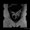 Broad ligament fibroid (Radiopaedia 49135-54241 Coronal T2 4).jpg
