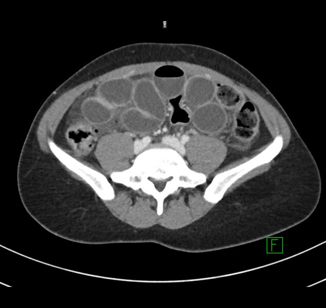File:Broad ligament hernia (Radiopaedia 63260-71832 A 49).jpg