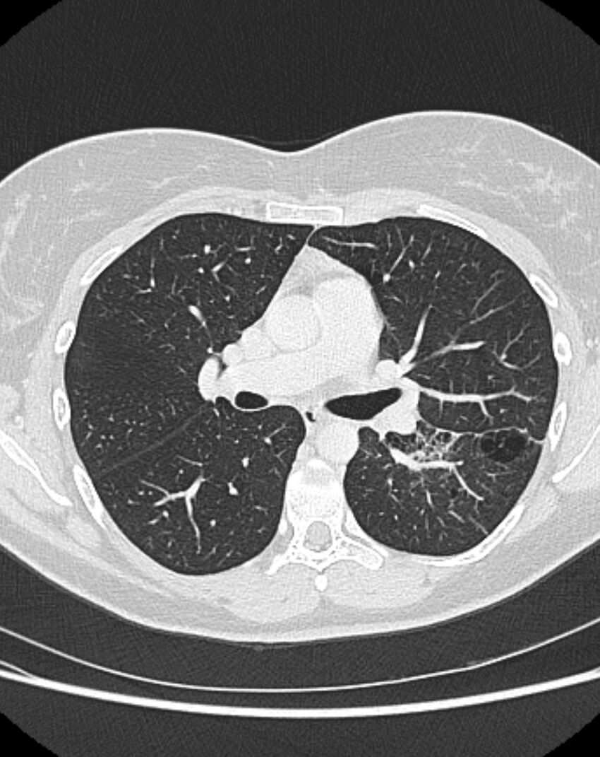 Bronchial atresia (Radiopaedia 50007-55297 Axial lung window 46).jpg