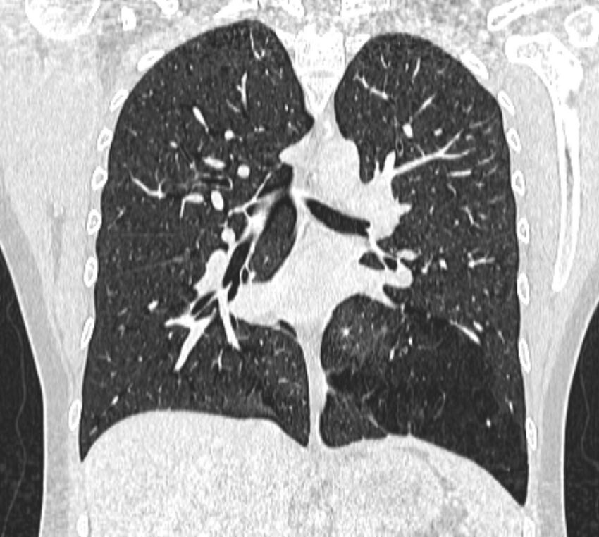 Bronchial atresia (Radiopaedia 50007-55297 Coronal lung window 62).jpg