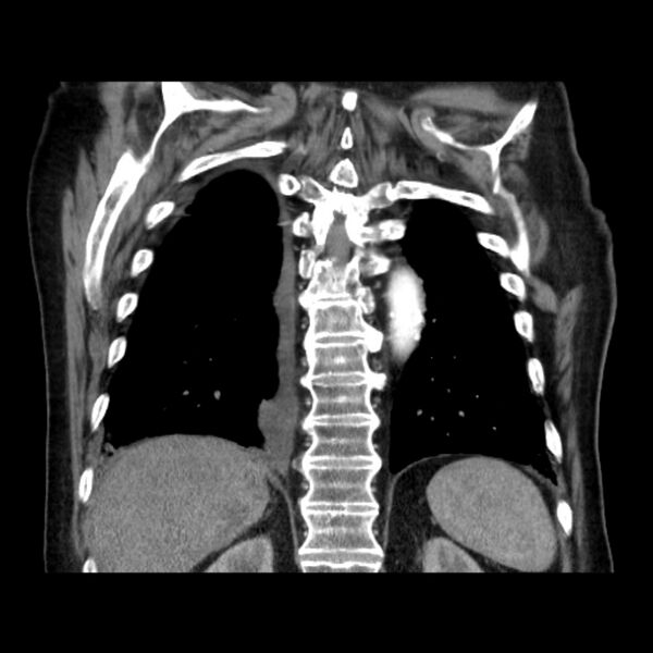File:Bronchogenic adenocarcinoma and pulmonary embolism (Radiopaedia 9097-9806 C 39).jpg