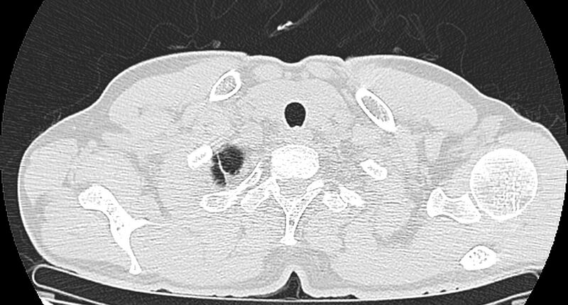File:Bronchogenic carcinoma with superior vena cava syndrome (Radiopaedia 36497-38054 Axial lung window 1).jpg