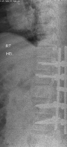 File:Bronchogenic cyst - mediastinal (Radiopaedia 19947-20148 Frontal 1).jpg