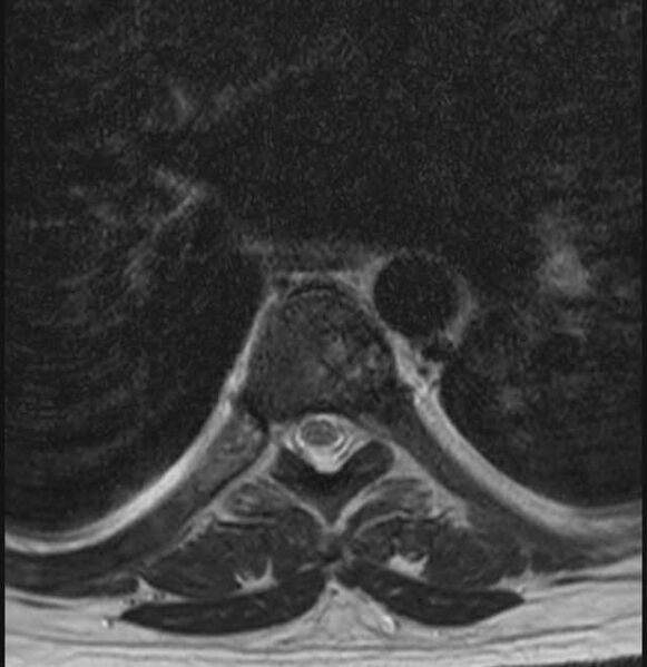 File:Brown tumors compressing the spinal cord (Radiopaedia 68442-78030 A 29).jpg