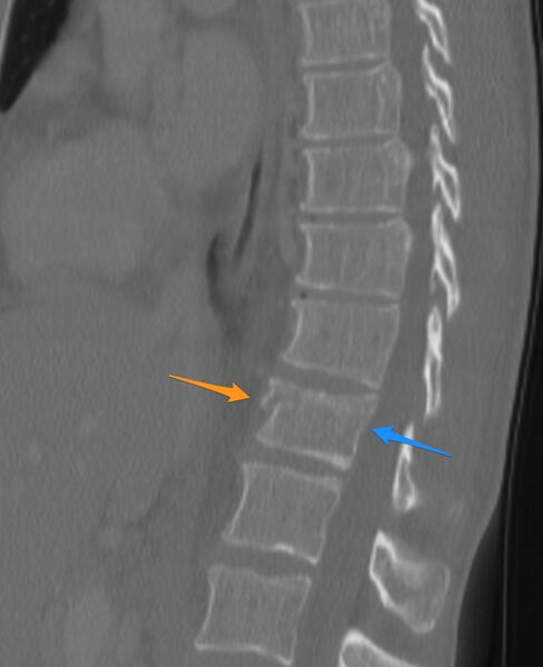 File:Bulging of paraspinal line in traumatic thoracal spinal compression fracture (Radiopaedia 29221-29619 C 1).jpg