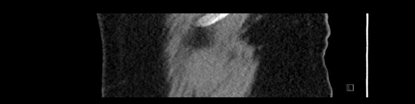 Buried bumper syndrome - gastrostomy tube (Radiopaedia 63843-72575 Sagittal Inject 117).jpg
