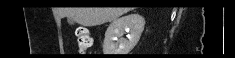 File:Buried bumper syndrome - gastrostomy tube (Radiopaedia 63843-72575 Sagittal Inject 95).jpg