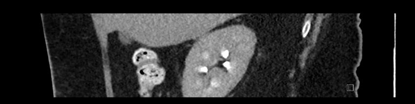 Buried bumper syndrome - gastrostomy tube (Radiopaedia 63843-72575 Sagittal Inject 95).jpg
