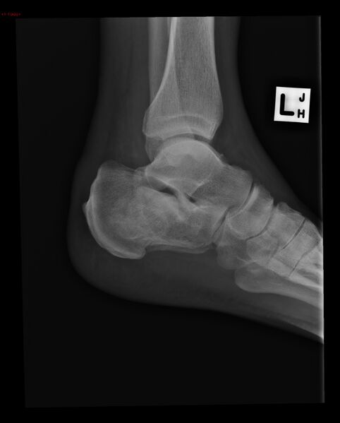 File:Calcaneal fracture and associated spinal injury (Radiopaedia 17896-17655 C 1).jpg