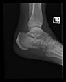 Calcaneal fracture and associated spinal injury (Radiopaedia 17896-17655 C 1).jpg