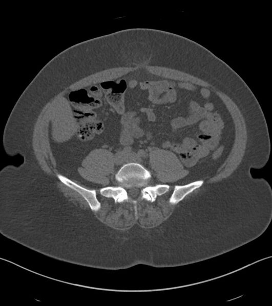 File:Calcified hepatic hydatid cyst (Radiopaedia 81127-94738 Axial non-contrast 66).jpg
