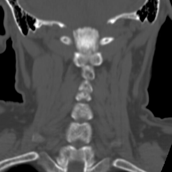 File:Calcified meningioma - cervical canal (Radiopaedia 70136-80171 Coronal bone window 24).jpg