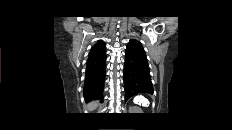 File:Calcified spleen (Radiopaedia 60952-68768 Coronal non-contrast 9).jpg