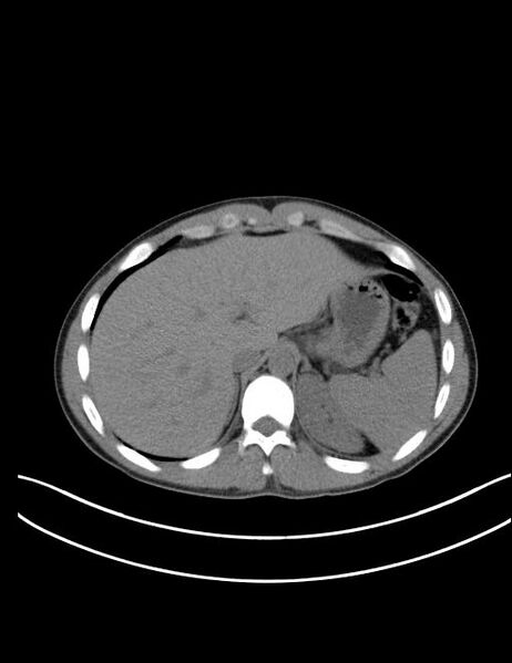 File:Calcifying pulmonary metastases (Radiopaedia 33359-34396 Axial non-contrast 28).jpg