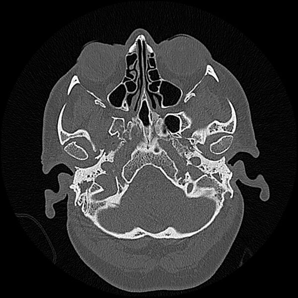 File:Canal up mastoidectomy (Radiopaedia 78108-90638 Axial bone window 34).jpg
