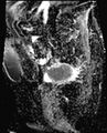Cancer cervix - stage IIb (Radiopaedia 75411-86615 Sagittal ADC 17).jpg