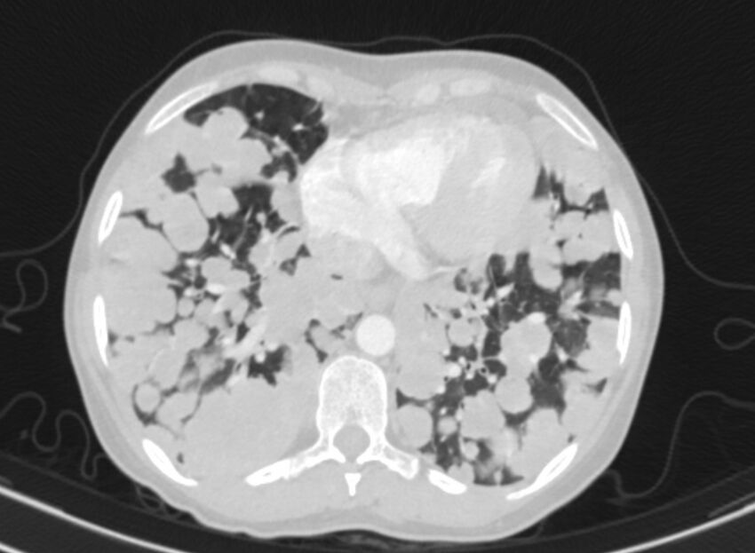 Cannonball metastases from breast cancer (Radiopaedia 91024-108569 Axial lung window 75).jpg