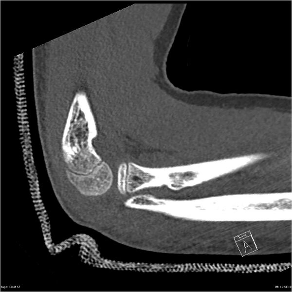 File:Capitellum fracture (Radiopaedia 23352-23426 Sagittal bone window 18).jpg