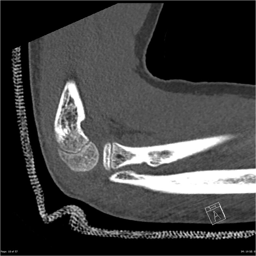 Capitellum fracture (Radiopaedia 23352-23426 Sagittal bone window 18).jpg