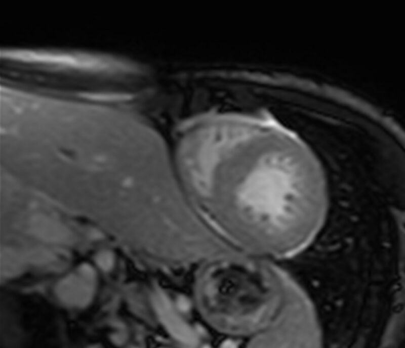 Cardiac amyloidosis (Radiopaedia 39736-42124 F 145).jpg