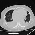 Cardiogenic pulmonary edema (Radiopaedia 29213-29609 Axial lung window 60).jpg