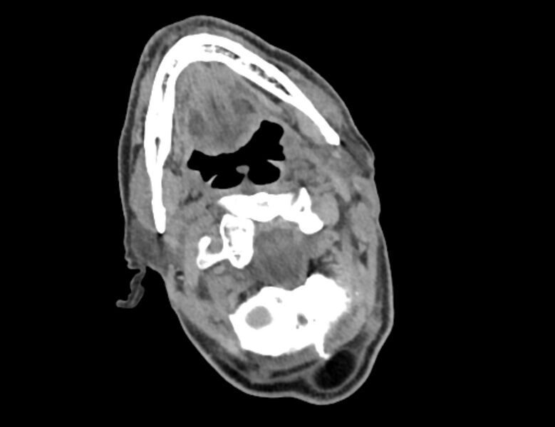 File:Carotid artery pseudoaneurysm (Radiopaedia 84030-99259 Axial non-contrast 6).jpg