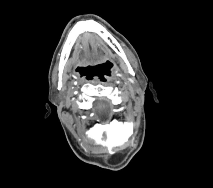 File:Carotid artery pseudoaneurysm (Radiopaedia 84030-99259 C 26).jpg