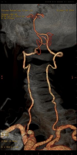 File:Carotid artery stenosis (Radiopaedia 28786-29086 B 3).jpg