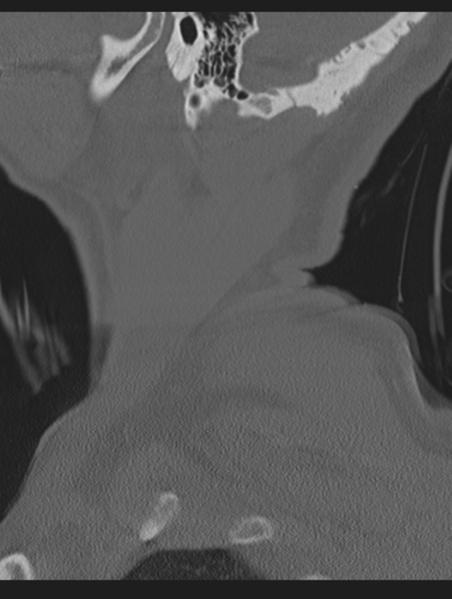File:Cavernoma of cervical cord (Radiopaedia 50838-56346 Sagittal bone window 4).png