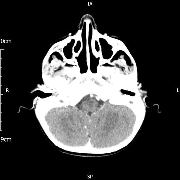 File:Cavernous sinus thrombosis (Radiopaedia 79414-92510 Axial Brain 60).jpg