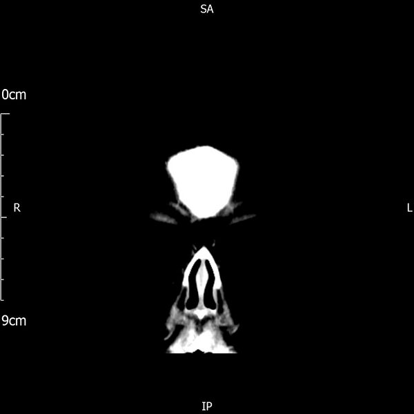 File:Cavernous sinus thrombosis (Radiopaedia 79414-92510 Coronal Brain 10).jpg